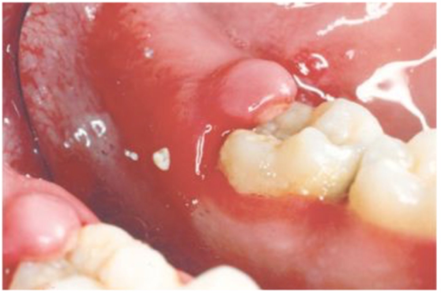<p>underlying osteitis</p><p>loss of cortical outline</p>
