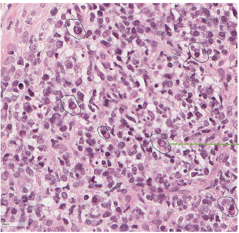 <p>plasma cells! = chronic inflammation </p>