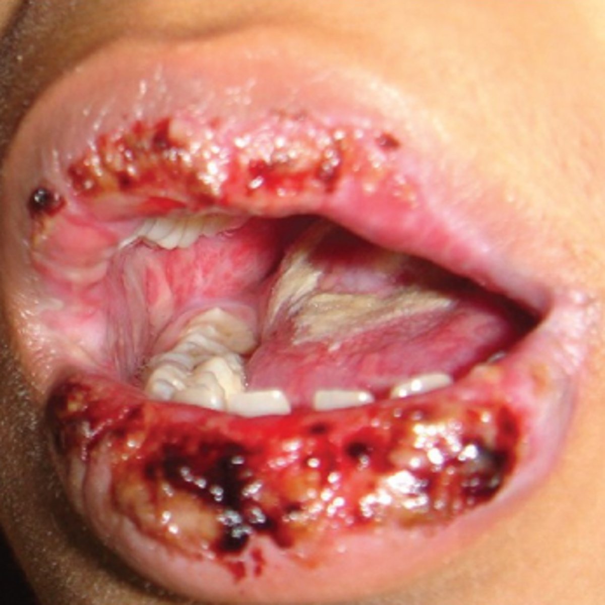 <p>Hint: Hemorrhagic crusting of lips</p>