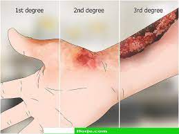 <p>Full-thickness burns. \n Destroys epidermis, dermis, and damage extends into hypodermis. \n Sensory nerves are destroyed. \n Skin grafting usually necessary.</p>