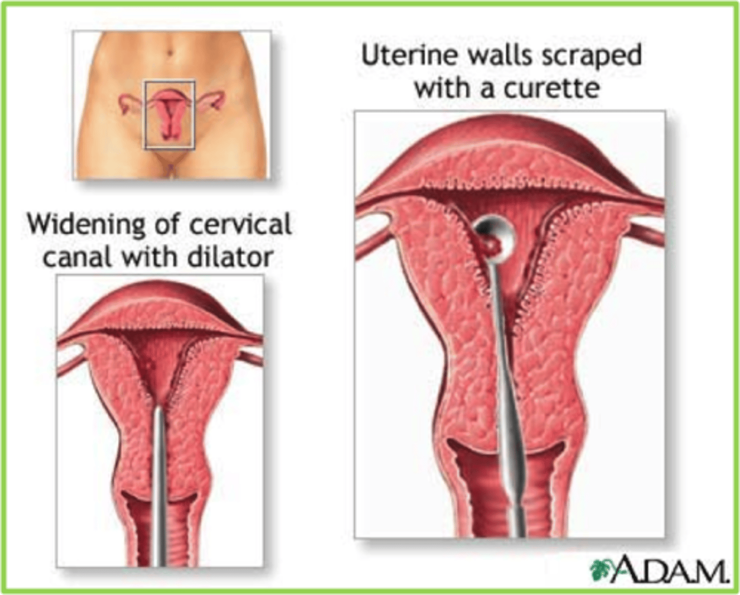 <p>A procedure to scrape and remove tissue from the inner lining of the uterus. The cervix is dilated (made larger) and a curette (spoon-shaped instrument) is inserted into the uterus to remove tissue.</p>