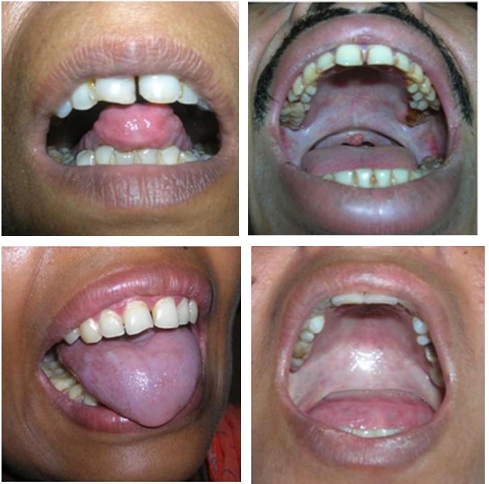 <p>which neoplastic white lesion clinical features:</p><ul><li><p>Mucosal blanching</p></li><li><p>Burning sensation (dry mouth)</p></li><li><p>Fibrous bands</p></li><li><p>Restriction in mouth opening</p></li><li><p>Shrunken and everted uvula</p></li><li><p>The tongue appears depapillated</p></li><li><p>could have precancerous mass but not the white lesion in question</p></li></ul><p></p>