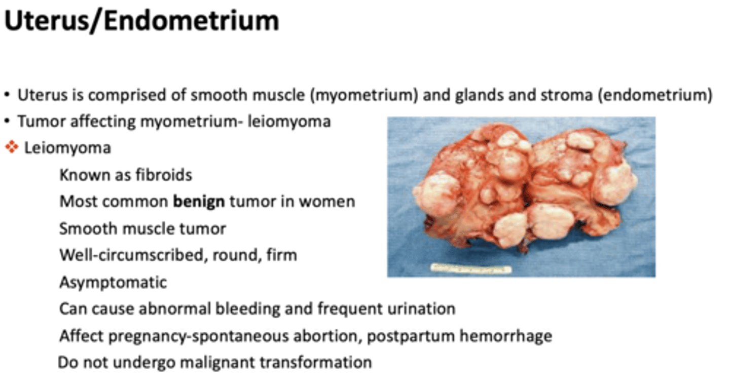 <p>leiomyoma</p>