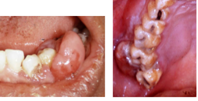 <p><span style="background-color: transparent; font-family: "Times New Roman", serif;">*Most common presentation: <strong>painless, persistent enlargement of lymph nodes</strong></span></p><p><span style="background-color: transparent; font-family: "Times New Roman", serif;">*Extra nodal disease can occur → mainly presents in soft tissue</span></p><p><span style="background-color: transparent; font-family: "Times New Roman", serif;">*Usually in patients >40 y/o</span></p><p><span style="background-color: transparent; font-family: "Times New Roman", serif;">*Increased incidence in AIDS patients</span></p><p><br></p><p><span style="background-color: transparent; font-family: "Times New Roman", serif;"><u>ORAL</u>:</span></p><p><span style="background-color: transparent; font-family: "Times New Roman", serif;"><strong>*Enlarged tonsil, painless palatal swelling, or gingival mass (may mimic inflammatory disease)</strong></span></p><p><span style="background-color: transparent; font-family: "Times New Roman", serif;"><strong>*Tumor isnontender, diffuse, boggy,</strong> <strong>discolored swelling (+/- ulcerated)</strong></span></p><p><span style="background-color: transparent; font-family: "Times New Roman", serif;"><strong>*Rarely can occur in jaw bones</strong></span></p>