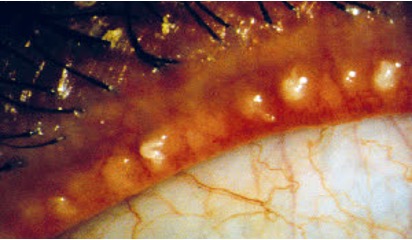 <p>chronic bilateral inflammation of meibomian gland</p>