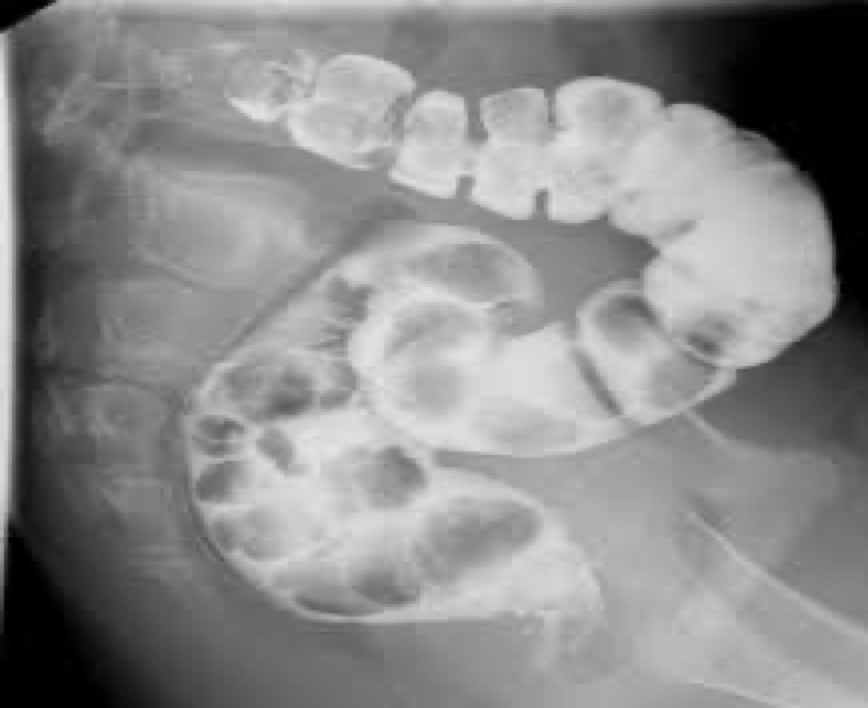 <p>Varicose veins of lower rectum- pain, itching, bleeding<br>Defect filling-look like polyps on distal rectum</p>