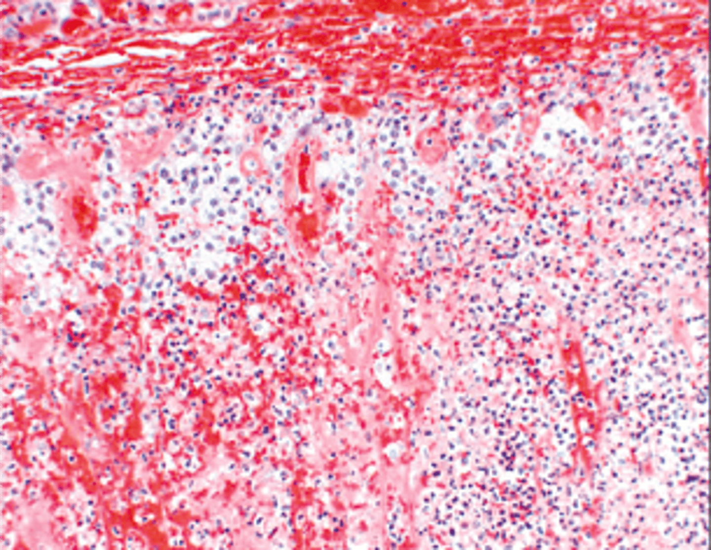 <p>Define Cause of Primary Adrenocortical Insufficiency:</p><p>-Hx:</p><p>&gt; Waterhouse-Friderichsen Syndrome = bilateral adrenal hemorrhage in the setting of sepsis (usually d/t Neisseria meningitidis); usually d/t sepsis-induced endothelial injury or DIC</p><p>&gt; Anticoagulant Therapy</p><p>&gt; Trauma</p>