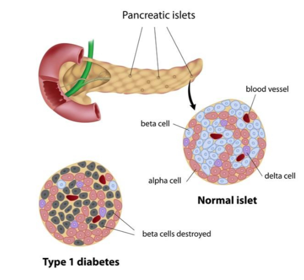 <p>Insulin beta-cells are attacked. Other islet cells may escape autoimmune attack. </p>