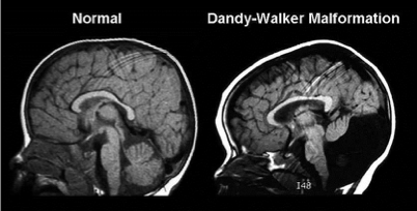 <p>partial or complete absence of the cerebellum<br><br>-Leads to dilation of 4th ventricle<br><br>-Noncommunicating hydrocephalus</p>