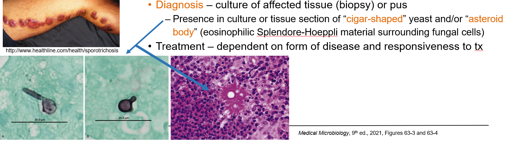 <p>By <strong>culture of affected tissue</strong> (biopsy or pus). In tissue, look for:</p><ul><li><p class=""><strong>“Cigar-shaped” yeast</strong></p></li><li><p class=""><strong>“Asteroid body”</strong> (yeast surrounded by eosinophilic <strong>Splendore-Hoeppli material</strong>)</p></li></ul><p></p>