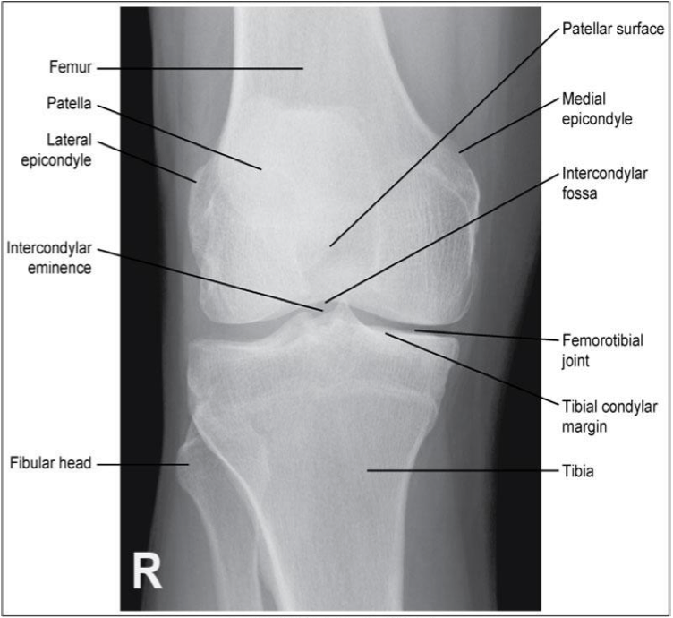 <p><span style="line-height: normal;"><span>• </span></span>Femorotibial joint space open</p><p class="p1"><span style="line-height: normal;"><span>• </span></span>Femoral condyles are symmetrical</p><p class="p1"><span style="line-height: normal;"><span>• </span></span>Femoral epicondyles in profile</p><p class="p1"><span style="line-height: normal;"><span>• </span></span>Knee joint centered to collimation field</p><p class="p1"><span style="line-height: normal;"><span>• </span></span>Articular facets of tibia on end</p><p class="p1"><span style="line-height: normal;"><span>• </span></span>Intercondylar eminence centered within the fossa</p><p class="p1"><span style="line-height: normal;"><span>• </span></span>Intercondylar fossa is barely seen</p><p class="p1"><span style="line-height: normal;"><span>• </span></span>Approx ½ of fibular head superimposed by tibia</p><p class="p1"><span style="line-height: normal;"><span>• </span></span>Head of fibula approx 1.25 cm from tibial plateau</p><p class="p1"><span style="line-height: normal;"><span>• </span></span>Patella sits slightly lateral to midline</p>