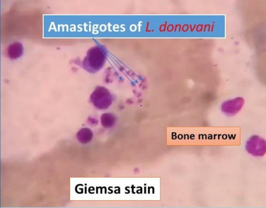 <p>Screening test for Hemoflagellates Leishmania spp. is called ___. This test is similar to the tuberculin skin test for the diagnosis of tuberculosis</p><ul><li><p>It is used as screening for large population at risk but not used for diagnosis</p></li><li><p>Definitive diagnosis is done by demonstration of the amstigote from <u>Giemsa stained slides of specimen </u>from blood, bone marrow, lymph nodes, and biopsies of infected areas.</p></li><li><p>Culture of blood, bone marrow, and other tisues may also be done, which will show the <u>promastigote forms.</u></p></li><li><p>Serologic tests are now available such as <u>indirect fluorescent antibody (IFA), enzyme-linked immunosorbent assay </u>(ELISA), or <u>direct agglutination test </u>(DAT).</p></li></ul><p></p>