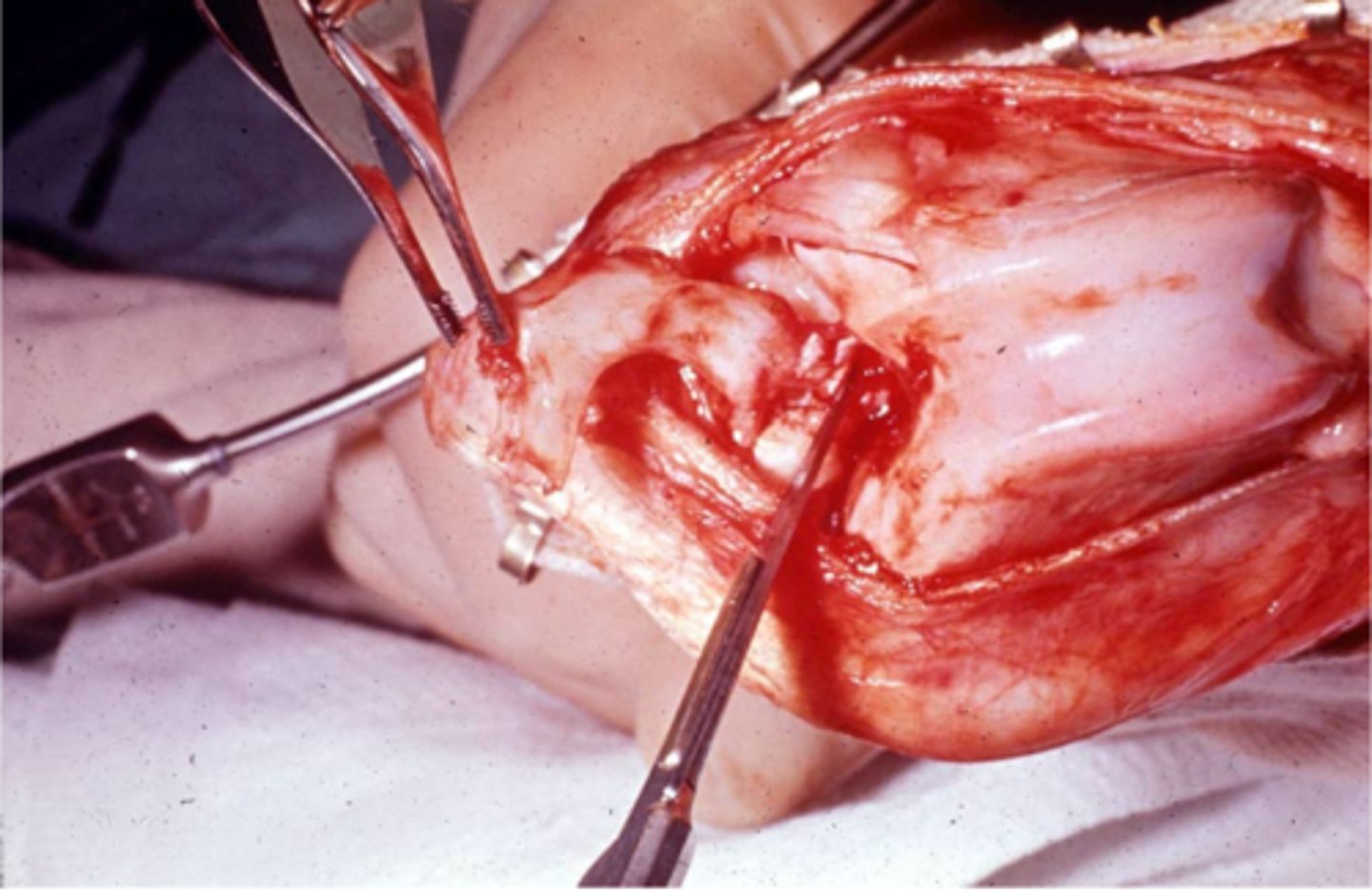 <p>what procedure is shown here</p>