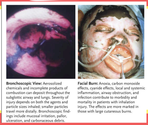 <p>Among the significant factors associated with mortality in burns, which is the worse one?</p><ul><li><p>%TBSA (total body surface area)</p></li><li><p>Inhalation injury</p></li><li><p>Involvement of the head, lower extremity, and perineum</p></li></ul><p></p>