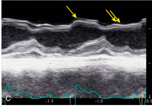 <p>What is the arrow pointing to?</p><p>What condition is this finding demonstrated in?</p>