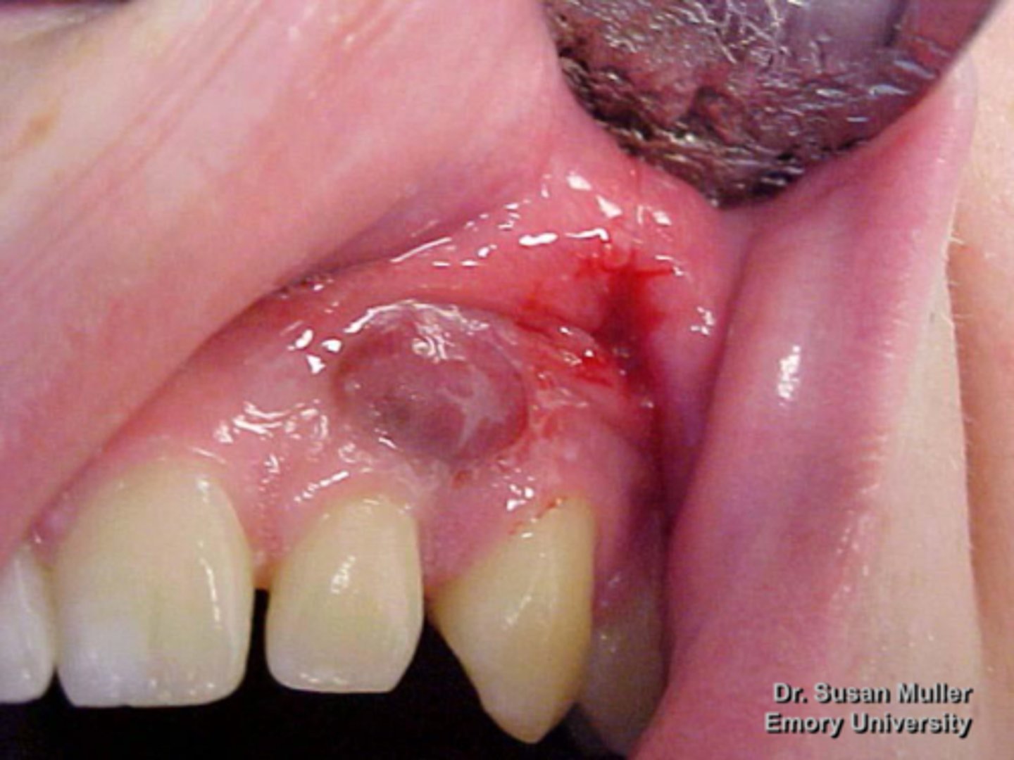 <p>patient presents with a purplish, slightly ulcerated nodule on the facial aspect of the maxillary gingiva. Histopathologic features show Multinucleated giant cells with up to several dozen nuclei, hemorrhage and hemosiderin. What do you suspect?</p>