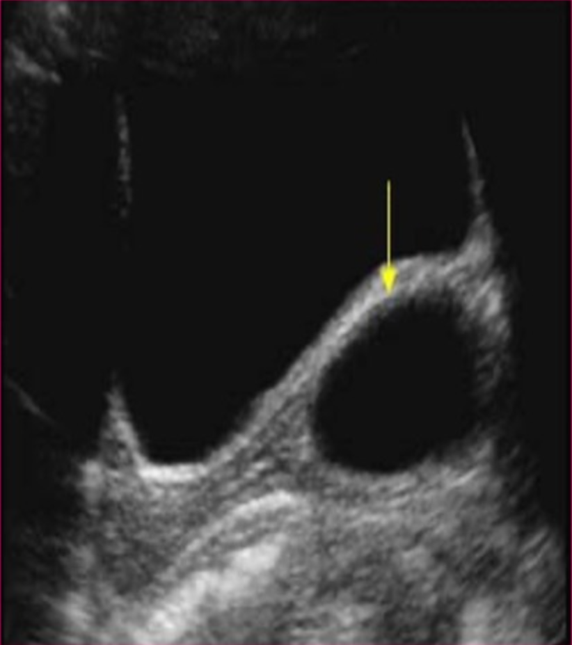 <p>What is the most common cyst of the vagina?</p>