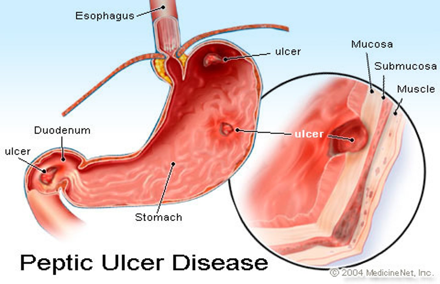<p>A sore that develops on the lining of the stomach or the duodenum.</p>
