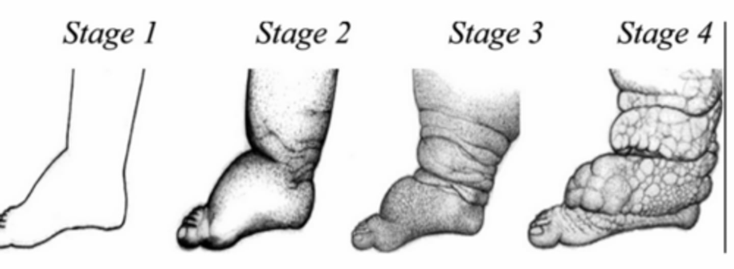 <p>- Most infections asymptomatic</p><p>- Chronic pathology associated with tissue damage/blockage caused by microfilariae</p><p>- Elephantiasis &amp; hydrocoele</p>