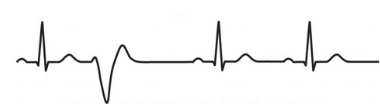 - Can occur within the atria or ventricles
- Premature and bizarrely shaped QRS complexes