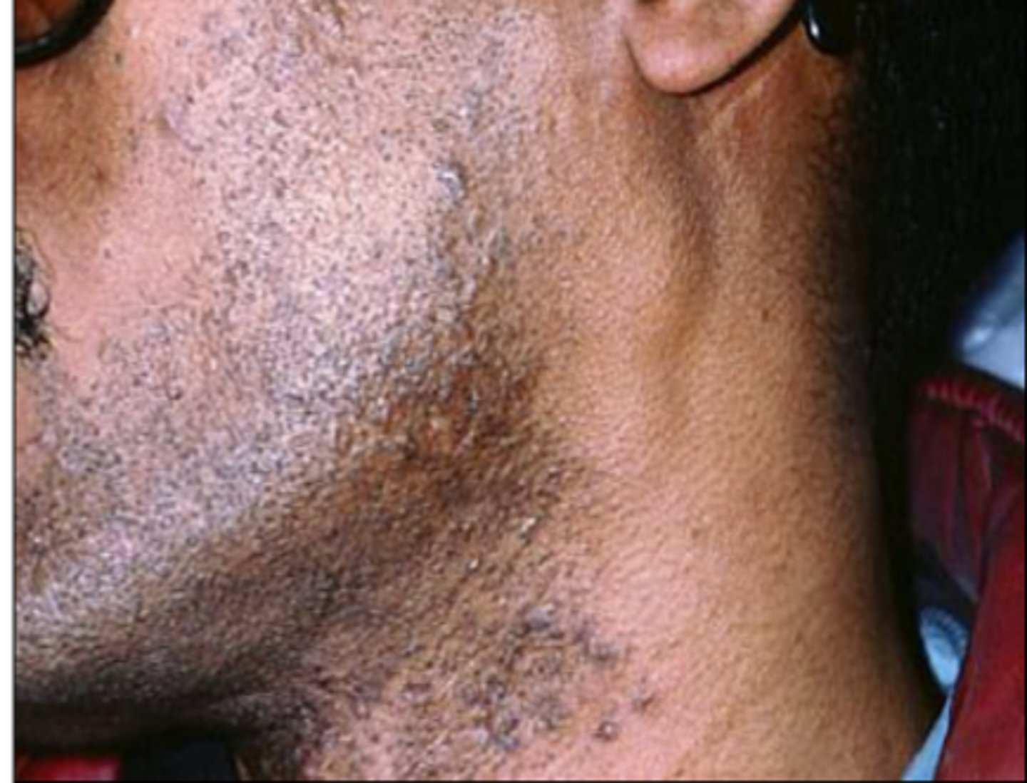 <p>often involves cervical lymph nodes and is non-tender</p>