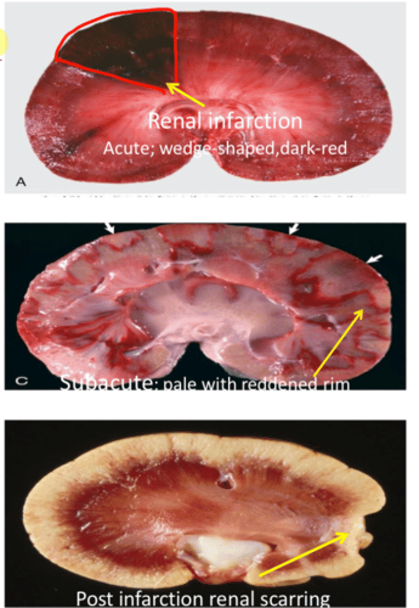 <p>Emboli/thromboemboli</p><p>Vasospasm</p><p>Extrinsic compression of a vessel</p><p>Traumatic rupture</p><p>Endotoxemia</p>