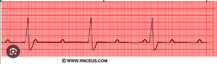 <p>type of abnormality + characteristics?</p>