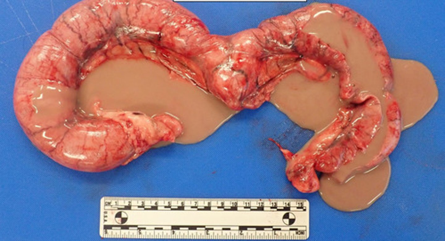 <p>What kind of necrosis is shown?</p>