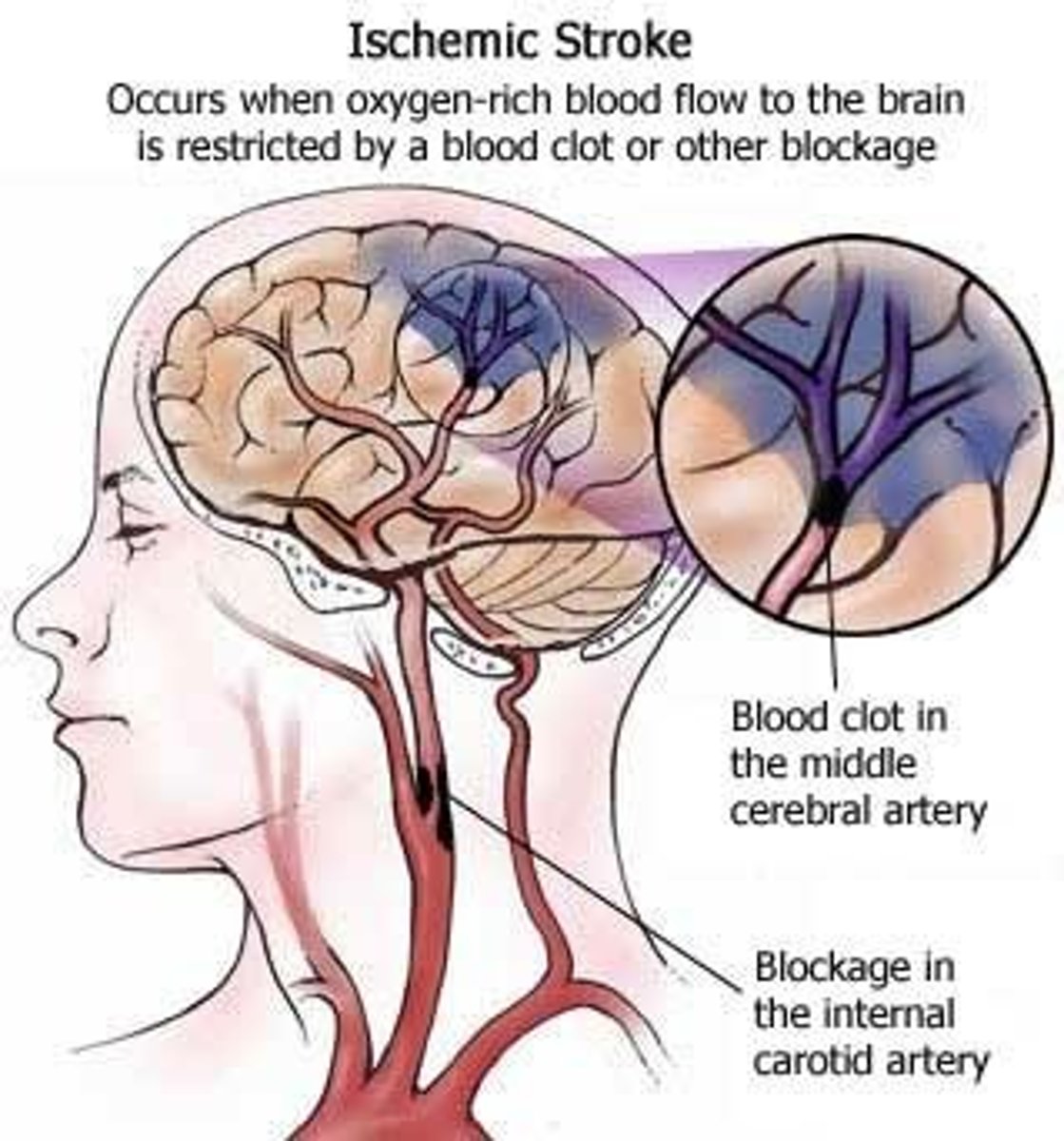 <p>temporary blockage of blood flow to the brain causing sudden, temporary stroke-like symptoms (weakness, confusion, vision loss) Causes: Atherosclerosis, heart attack, abnormal heart rhythms, sharp drop in blood pressure</p>