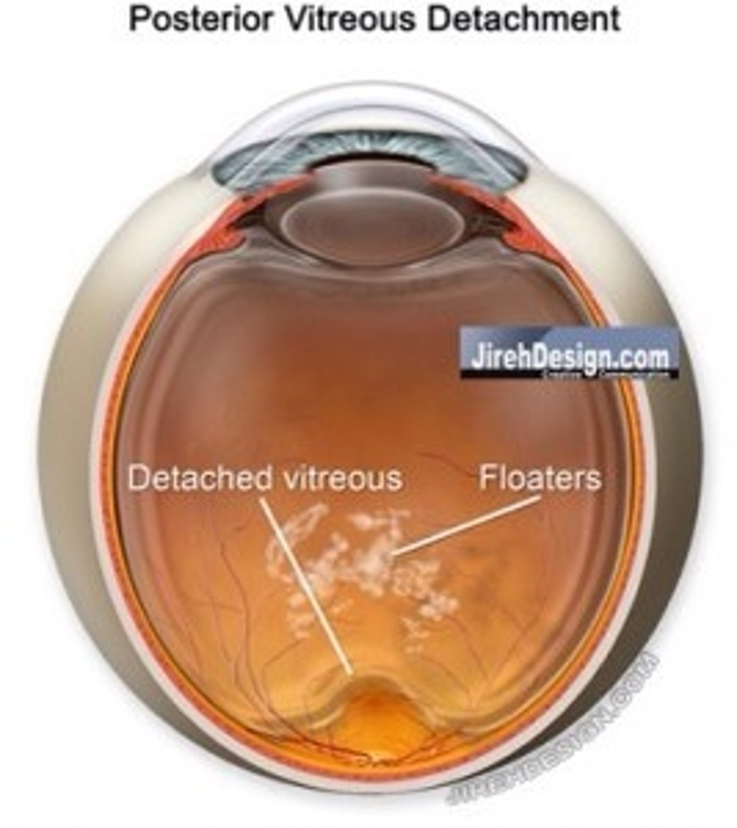 <p>Vitreous detachment</p>