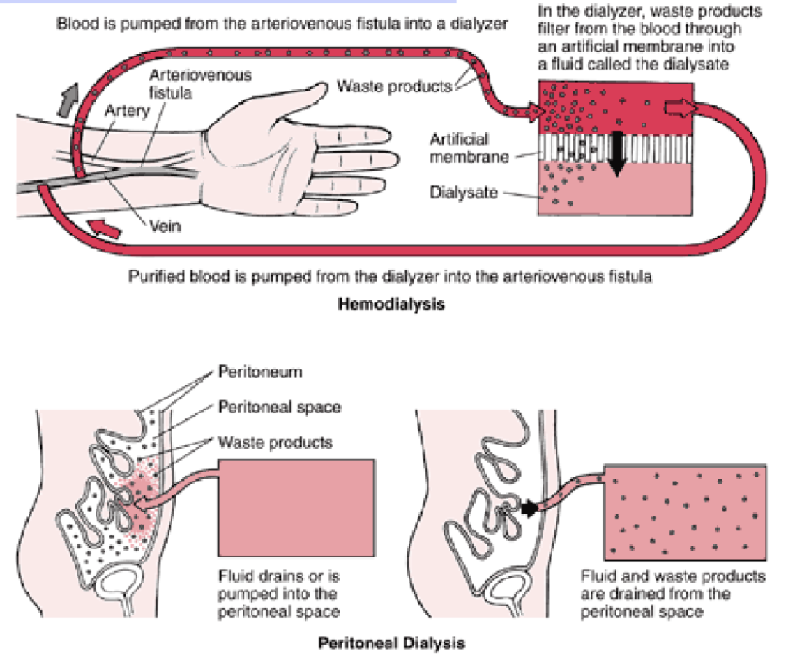 <p>Expose “dirty” blood to clean dialysate across a semi-permeable membrane (hemodialysis vs peritoneal dialysis)</p>