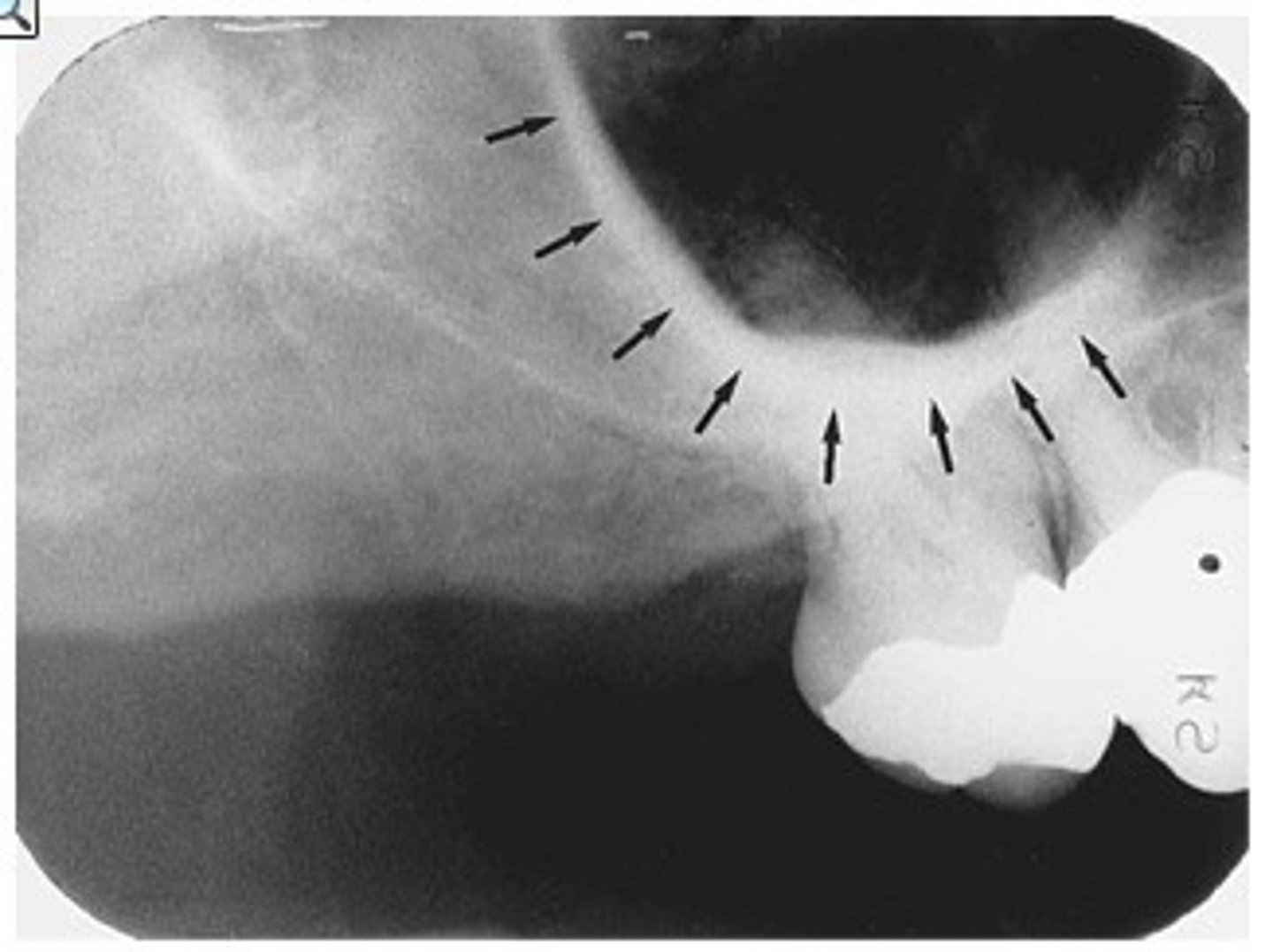 <p>A J- or U-shaped radiopacity located superior to the maxillary first molar region</p>
