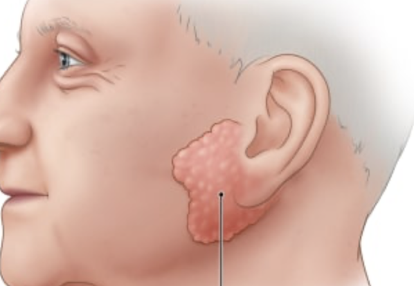 <p>anterior to ear and external to masseter muscle; opens into oral vestibule and next to second upper molar</p>