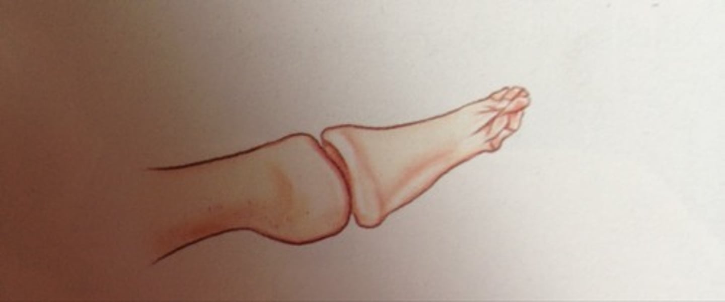 <p>comminuted fx of distal phalanx (usually crush injury)</p>