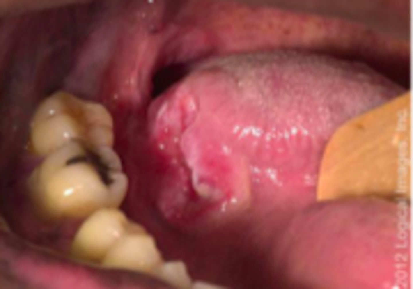 <p>Bacterial ID:</p><p>Objective:</p><p>- Begins as a painless papule</p><p>- Ulcerates to produce an ulcer</p><p>- Mild-moderate regional lymphadenopathy, usually bilateral</p><p>- Usually occur at genitalia but can develop at other sites (posterior pharynx, anus, vagina)</p>
