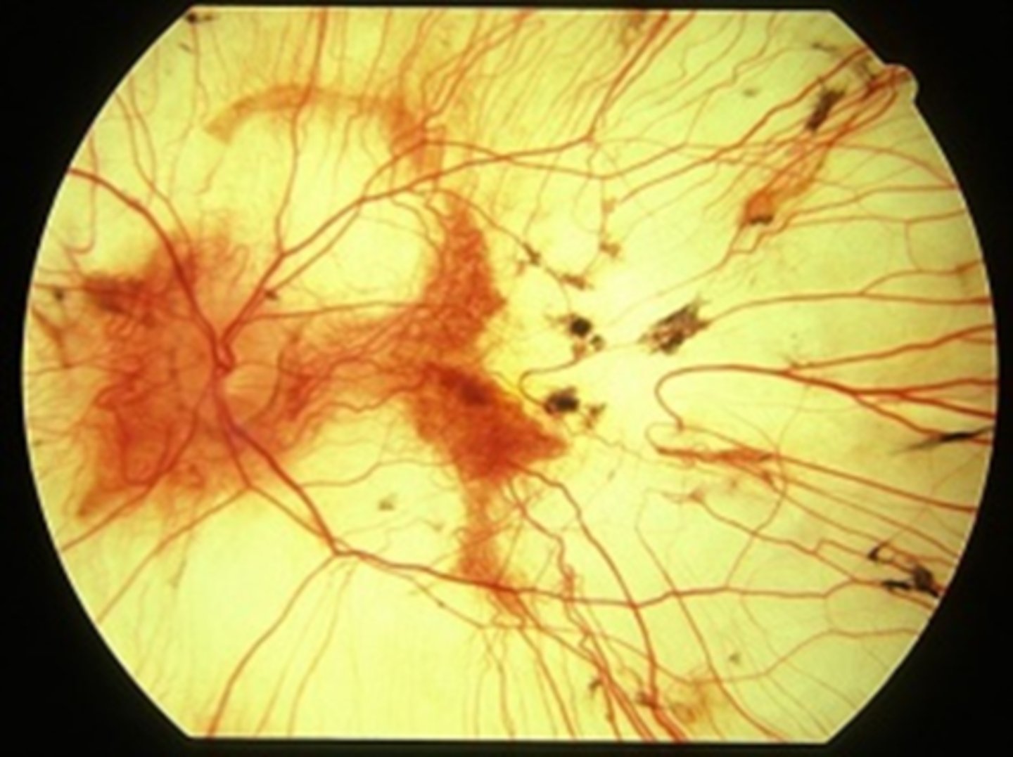 <p>NORMAL appearing retinal BV</p><p>NO optic atrophy</p>