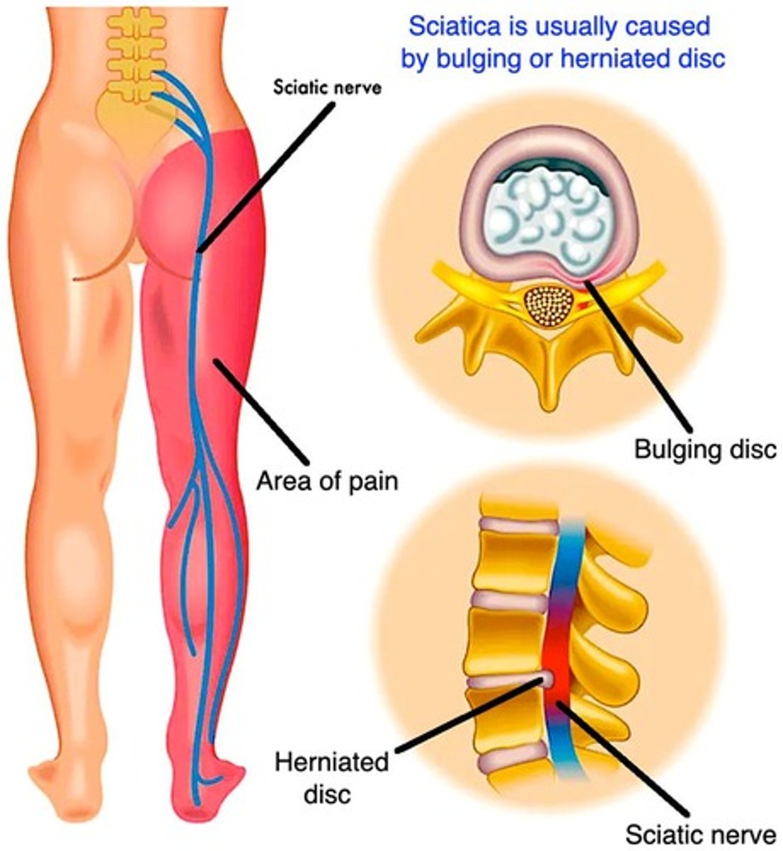 <p>Anterior cerebral artery stroke leads to motor/sensory abnormalities of contralateral leg.</p>