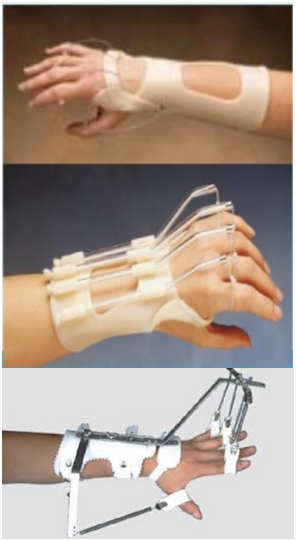 <p>What is the use of a dynamic finger extension splint (aka dynamic radial nerve splint)? </p>