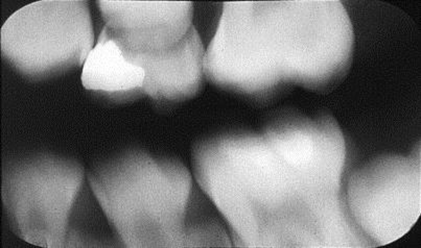 <p>Appearance-Blurred images appear on the plate</p><p>Cause-The patient moved during exposure of the plate</p><p>Correction-Instruct the patient to remain still while the plate is being exposed</p>