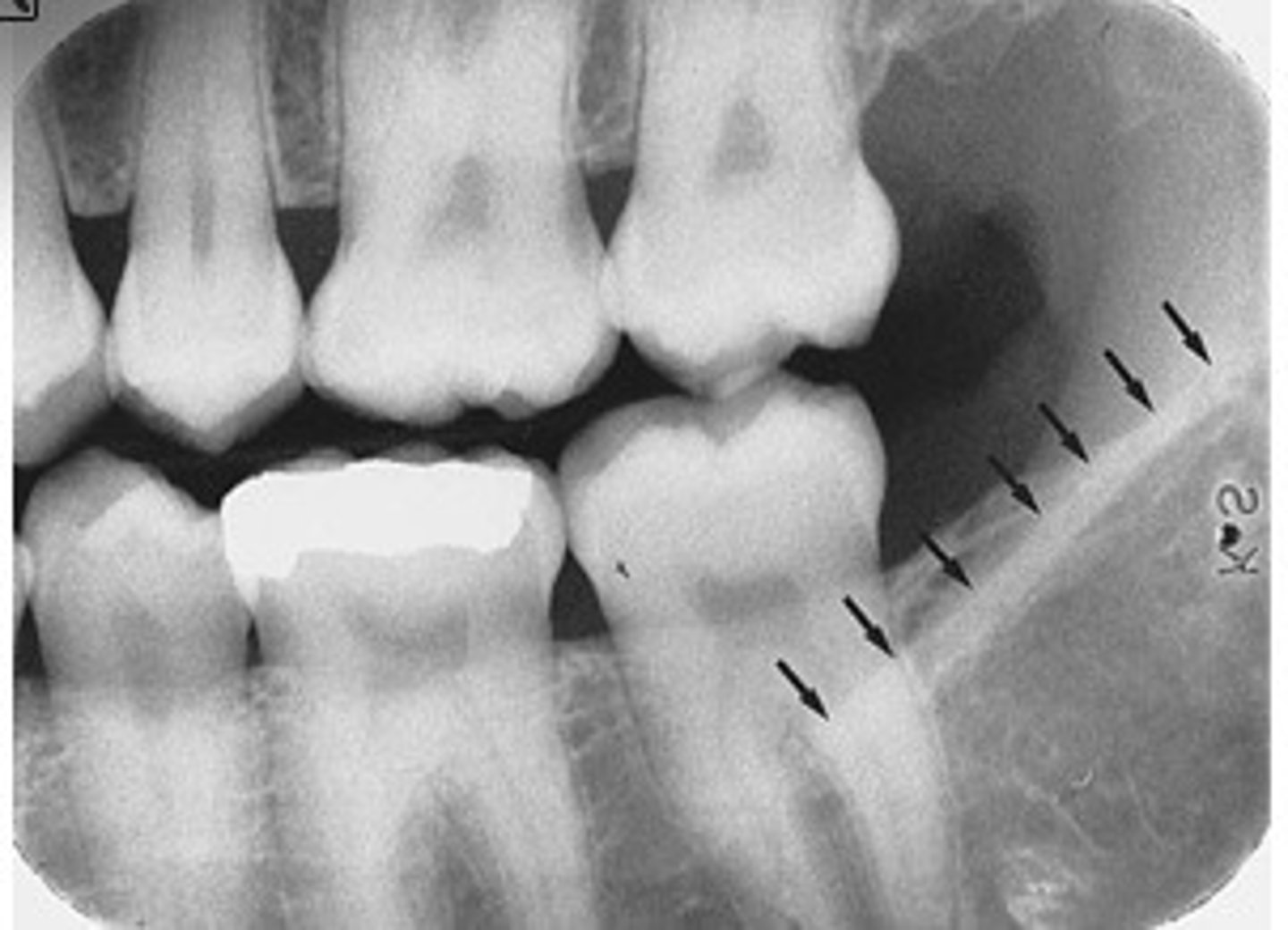 <p>...A radiopaque band extending downward and forward from the anterior border of the ramus of the mandible</p>