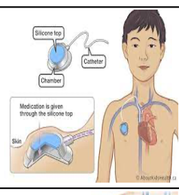 <p>infusaport, port-a-cath, mediport</p>