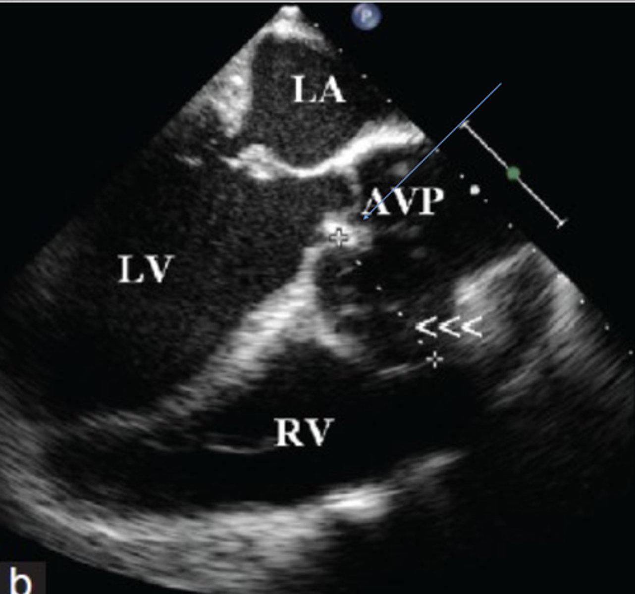 <p>More common with disk valves</p><p>Cystic area with neck near valve annulus</p>