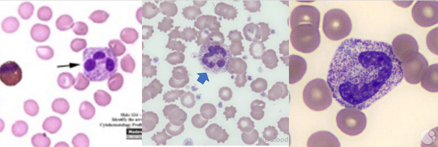 <p>A. Identify the abnormality / cell</p><p>B. This is seen in what condition / disease</p>