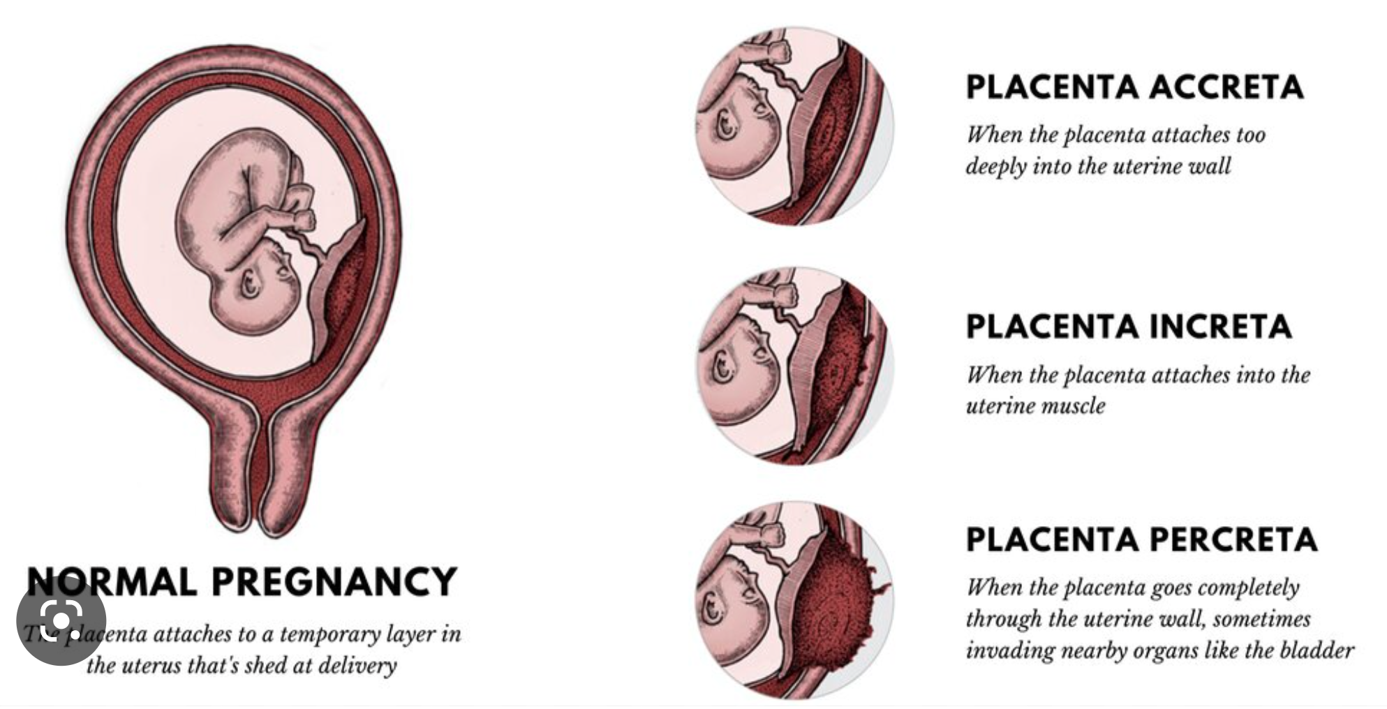 <p>Slight penetration of myometrium</p>