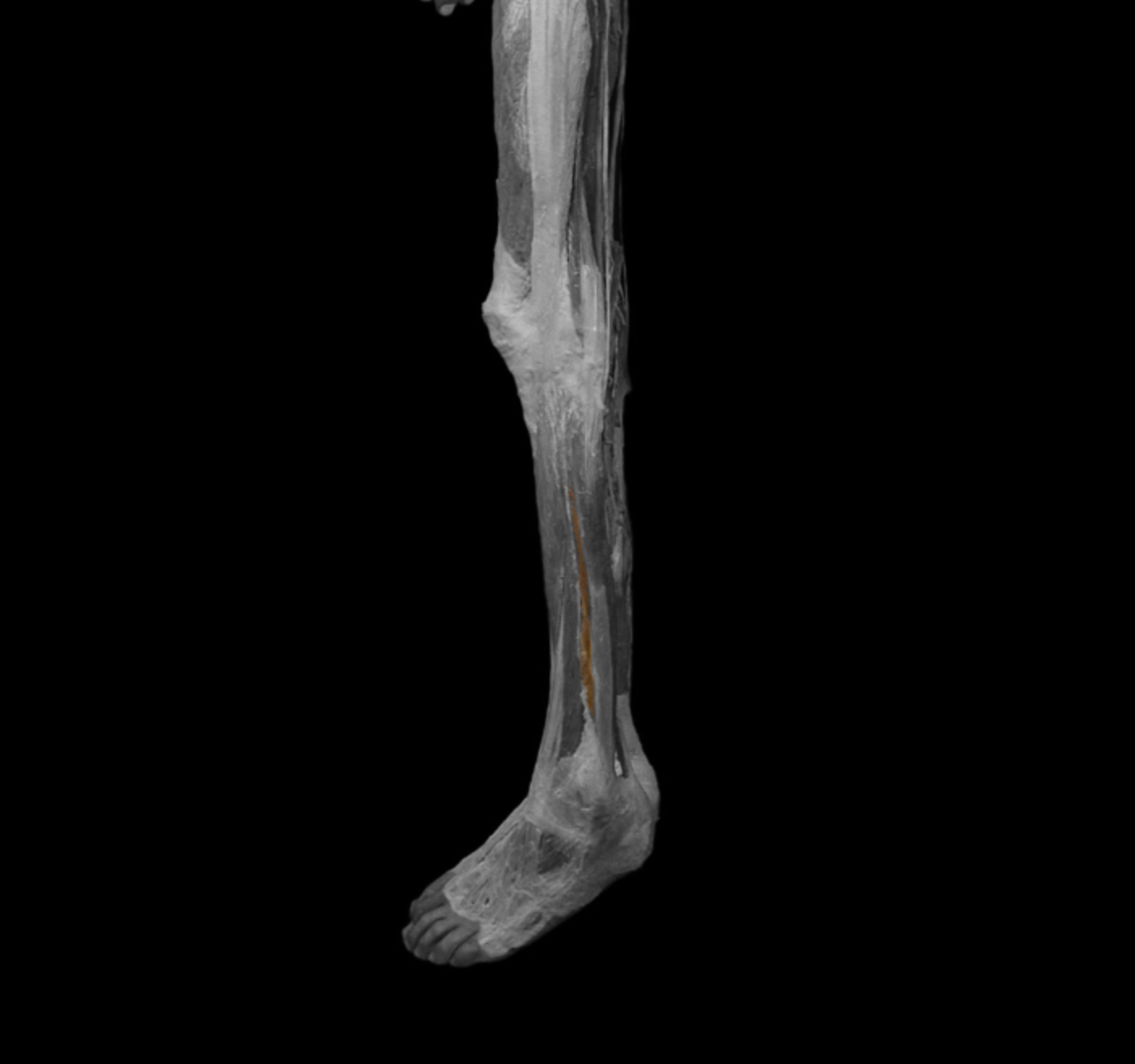 <p>origin: body of fibula </p><p></p><p>insertion: base of metatarsal V </p><p></p><p>action: plantar flex foot, pronate foot </p><p></p><p>innervation: superficial fibular nerve </p>