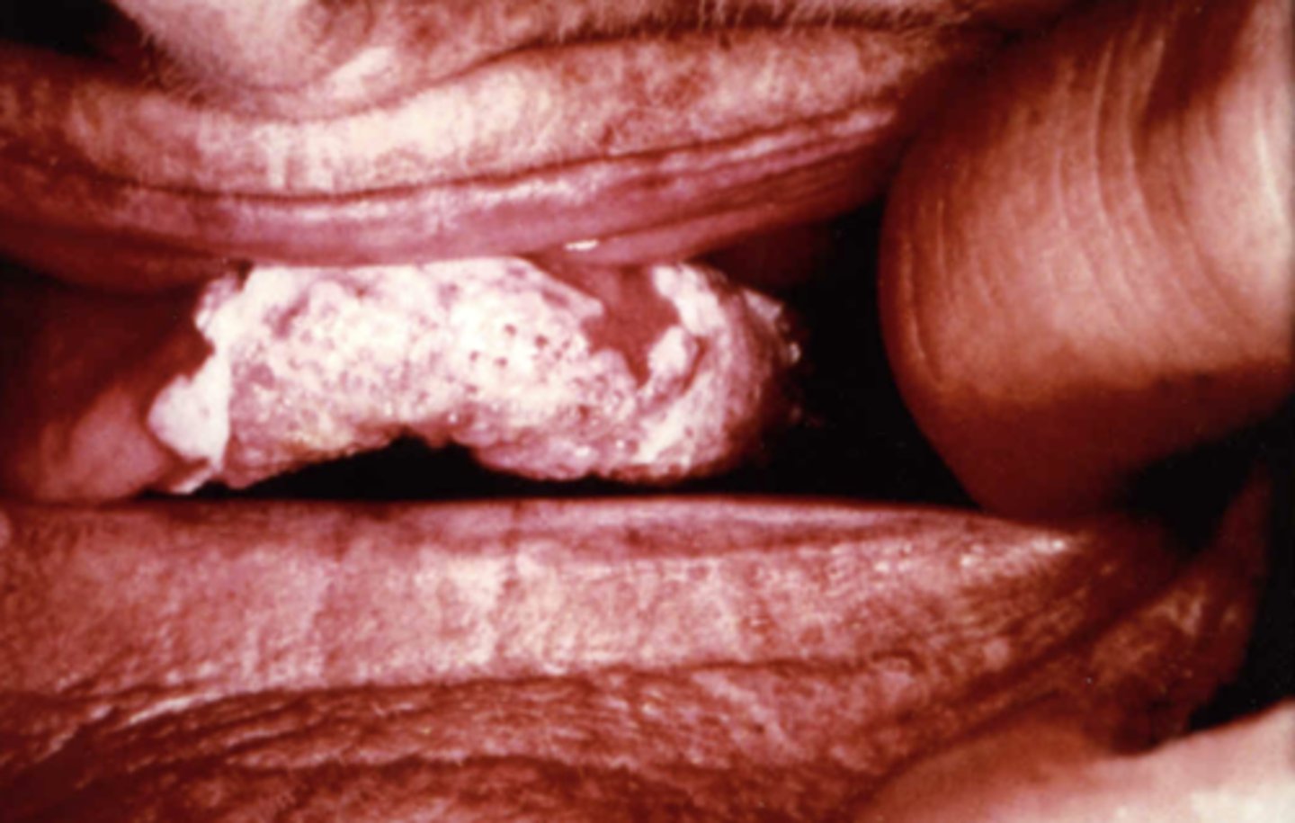 <p>White, warty leukoplakia with thickened areas</p><p>- Txt: Serial biopsies over time, can use CO2 laser</p>