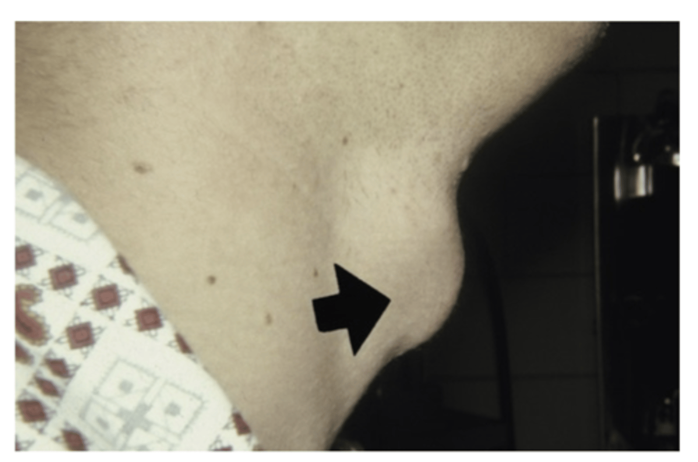 <p>What is a Thyroglossal duct cyst? Where do they develop? What are they typically adjacent to? </p>