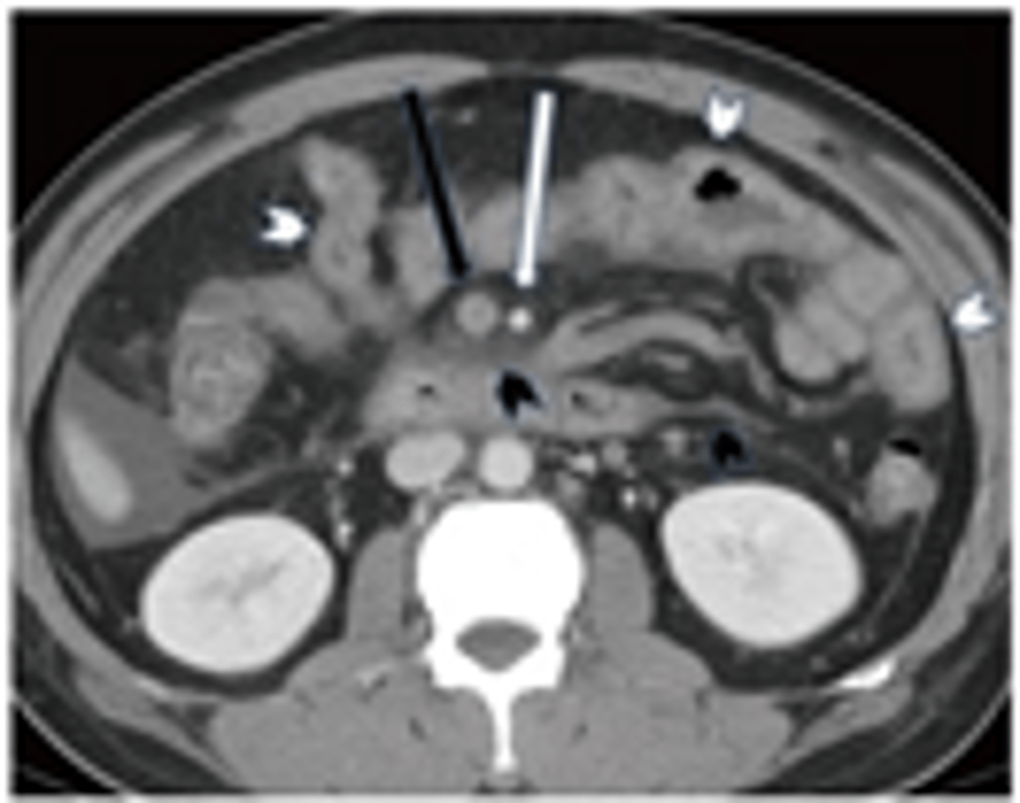 <p>MR Venography vs CTA</p><p>Tx: NGT/IVF, anticoagulation or refer to vascular surgeon for transvenous thrombolysis/ thrombectomy </p><p>(Dx = Mesenteric Venous Thrombosis with 2ndary ileus) </p>
