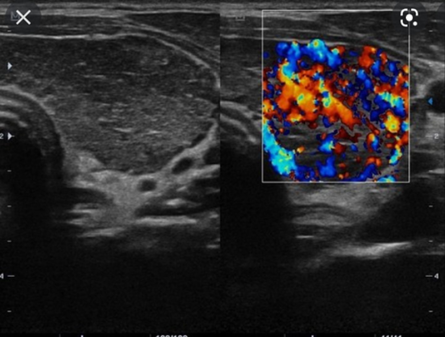 <p>Etiology</p><p>-Chronic lymphatic inflammatory disease</p><p>Clinical findings</p><p>-Often painless</p><p>-Hypothyroidism</p><p>-Leukocytosis</p><p>-Sore throat</p><p>-Fever</p><p>Sonographic findings</p><p>-Enlarged hypoechoic thyroid glands</p><p>-Hypervascular parenchyma</p>