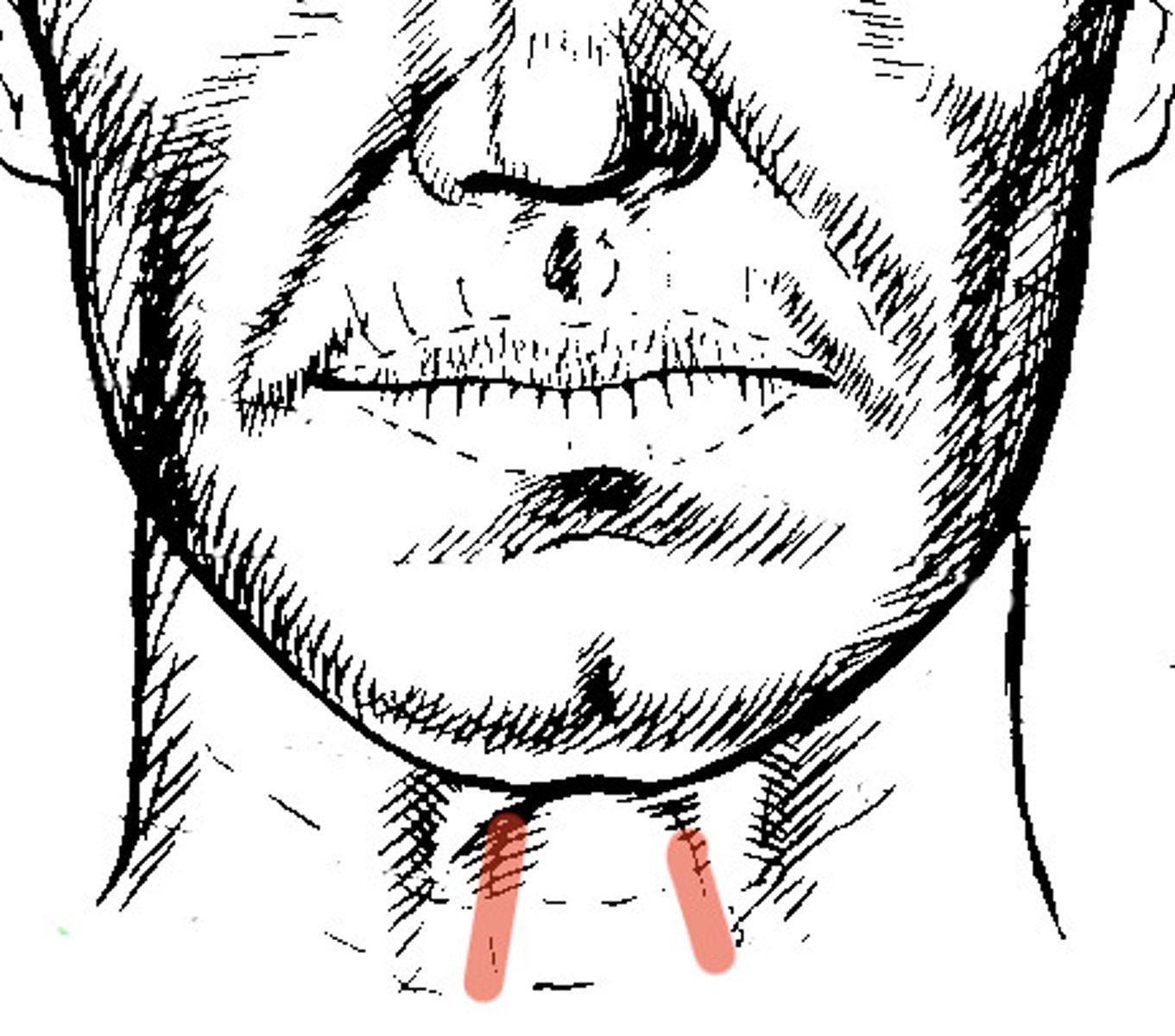 <p>vertical prominences of the neck; acquired</p>